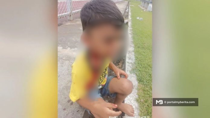 Budak 7 tahun parah diserang lapan anjing liar